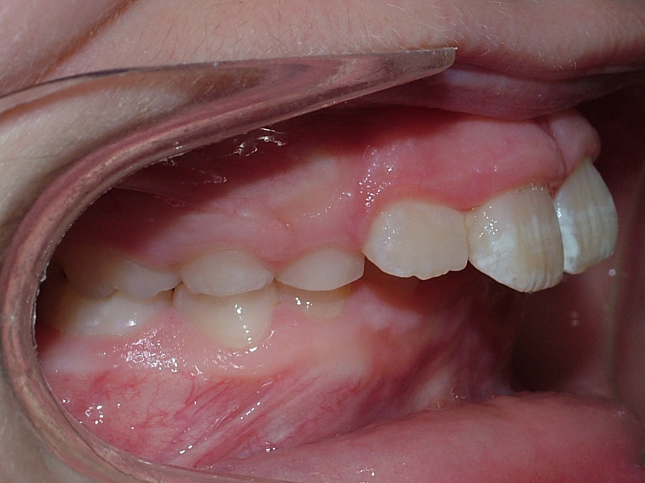 Class II Overbite